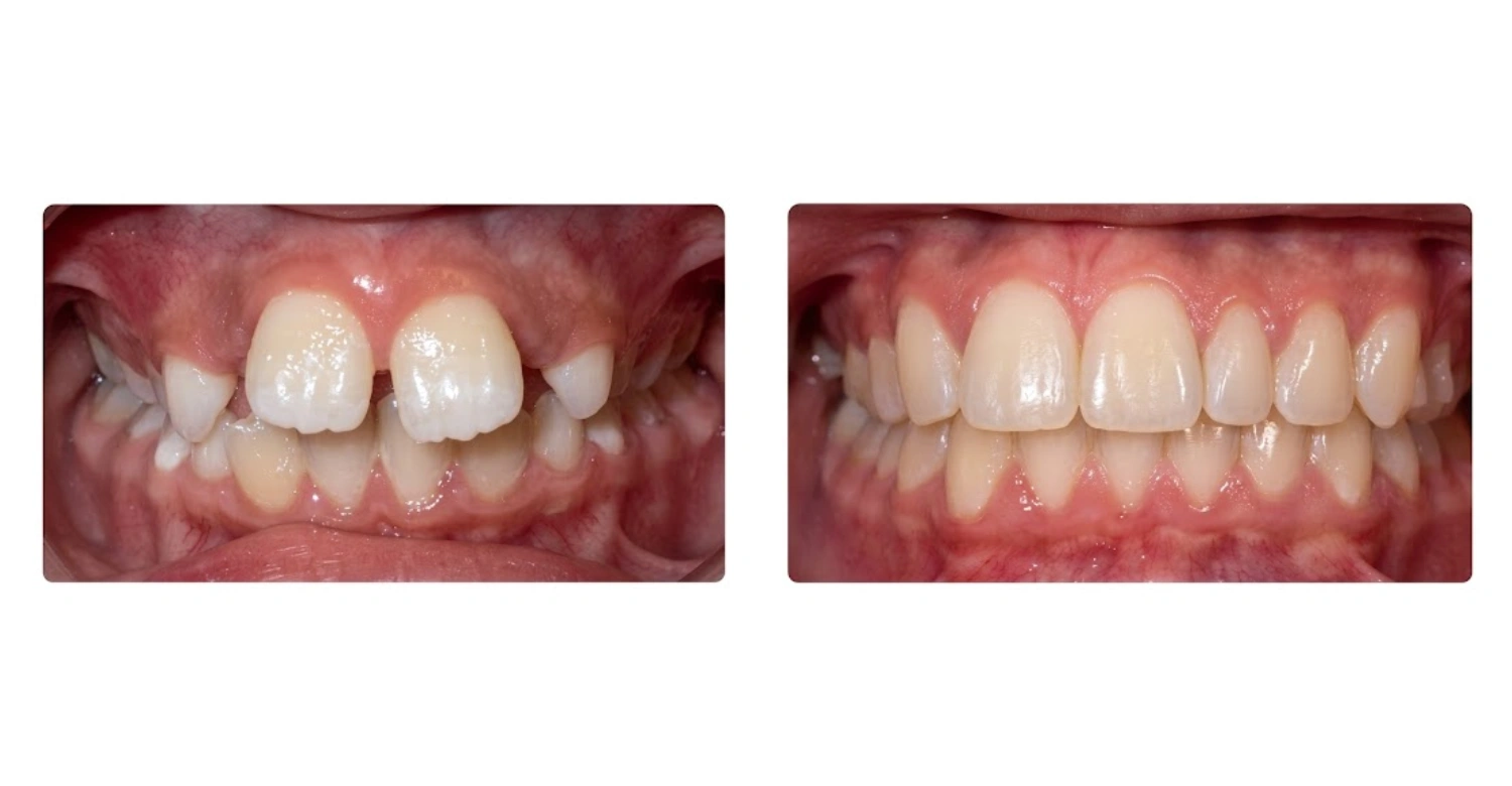 is phase 1 orthodontics necessary inblog